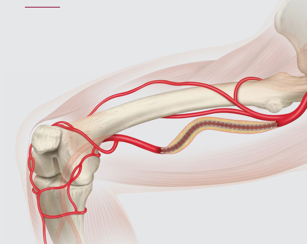 Long Lesions, Long-Term Thinking: Best Practices for Treating Complex Femoropopliteal Disease