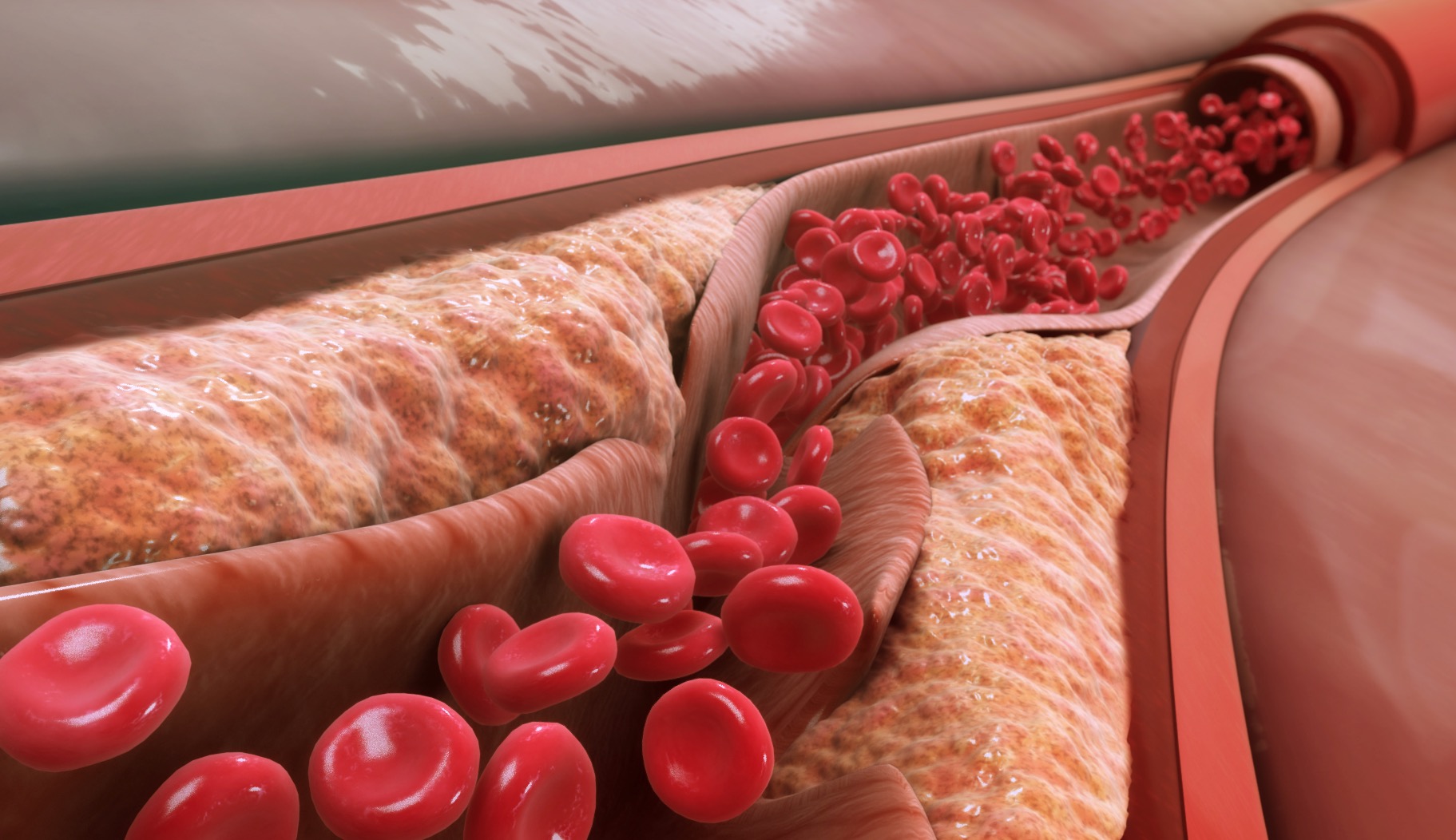 Crossing Chronic Total Occlusions in the Tibials: Techniques, Tools, and Tips