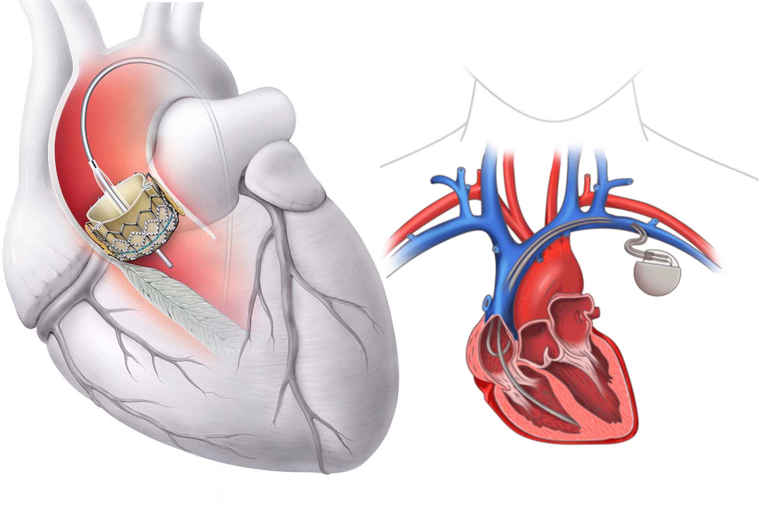 Conduction Disturbances Post-TAVI: Risk Factors, Monitoring, and When to Implant a Pacemaker