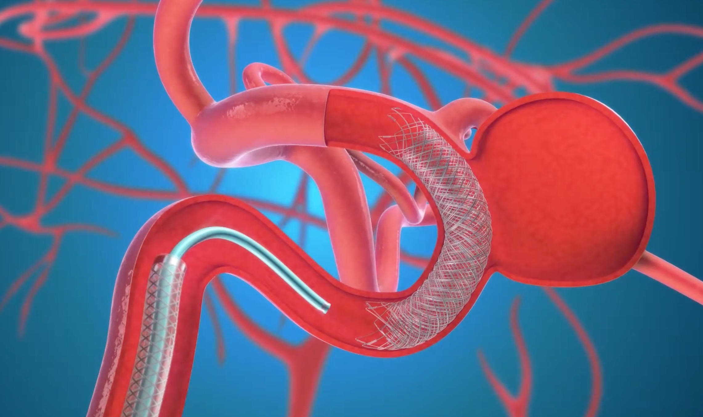 Device Selection for Complex Aneurysms: Flow Diversion vs Coiling vs Stent-Assisted Techniques
