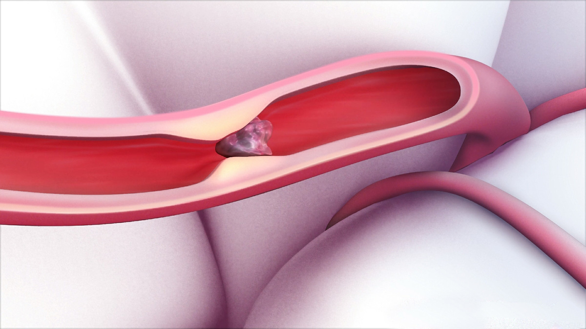 Beyond the Clot: Understanding the Role of Collateral Circulation in Acute Ischemic Stroke Intervention