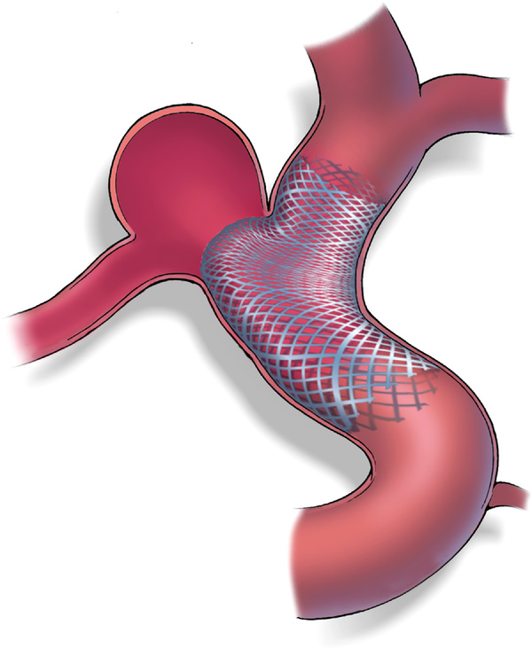 Device Selection for Complex Aneurysms: Flow Diversion vs Coiling vs ...